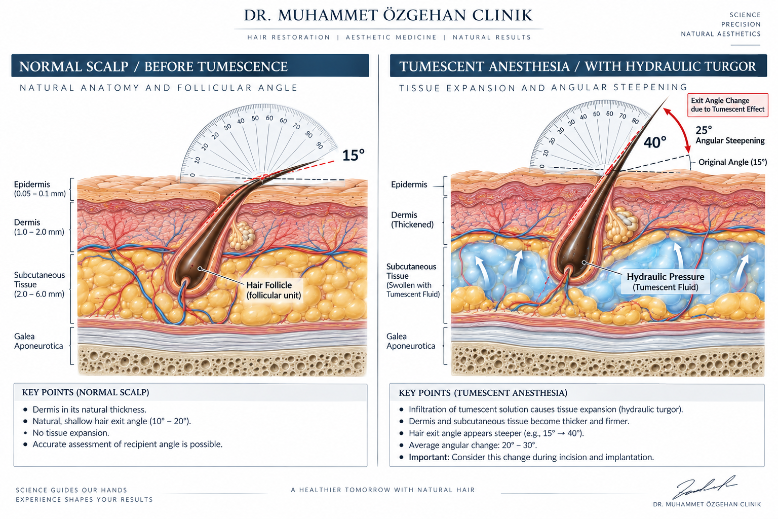 Tümesan anestezi öncesi ve sonrası kafa derisi anatomisi ve açısal değişim
